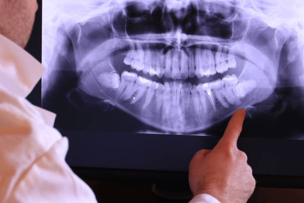 Best Emergency Dental Extractions in Houghton, NY